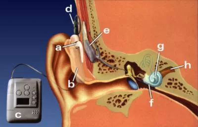 Anatomia Cocleare Cochlea Radiology Reference Article Anatomia Cocleare Cochlea Radiology Reference Article